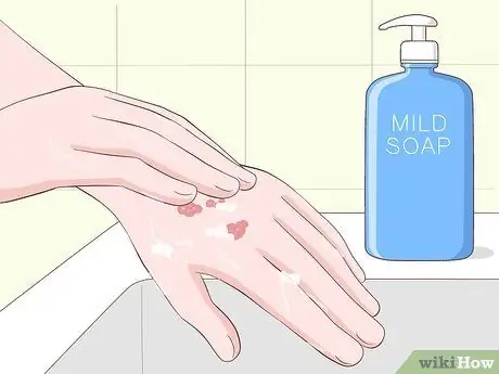 Лечение шрамов от чесотки, шаг 15