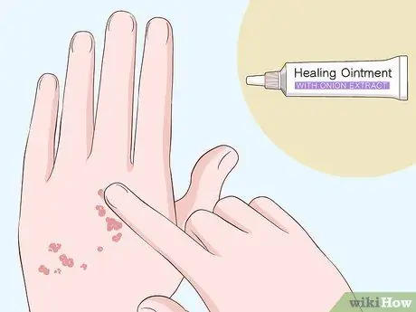 Лечение шрамов от чесотки, шаг 2