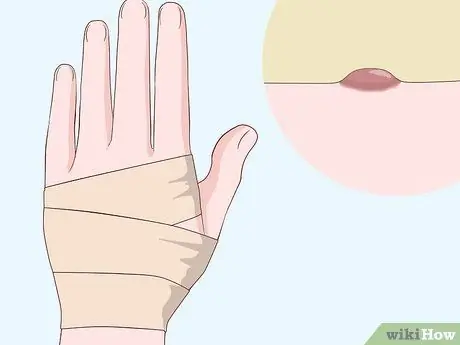 Лечение шрамов от чесотки, шаг 4