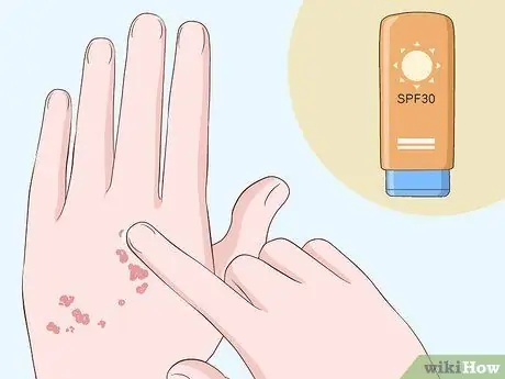 Исцеление шрамов от чесотки, шаг 6