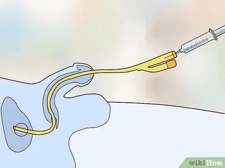 Вставьте катетер Шаг 10