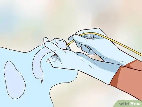 Вставьте катетер Шаг 8