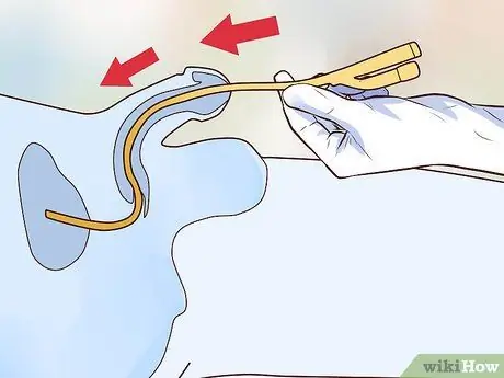 Вставьте катетер Шаг 9