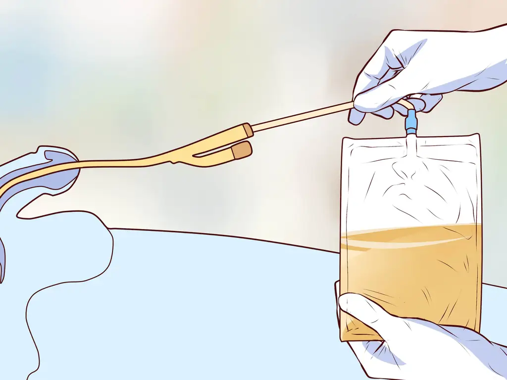 Как вставить катетер: 11 шагов (с изображениями)