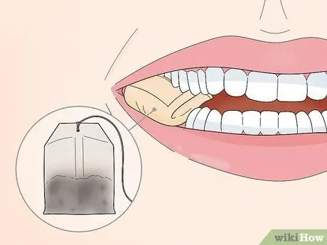 Восстановление после операции на зубах мудрости Шаг 6