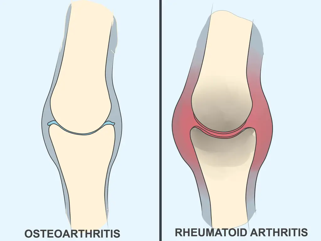 Как распознать симптомы артрита: 11 шагов (с изображениями)