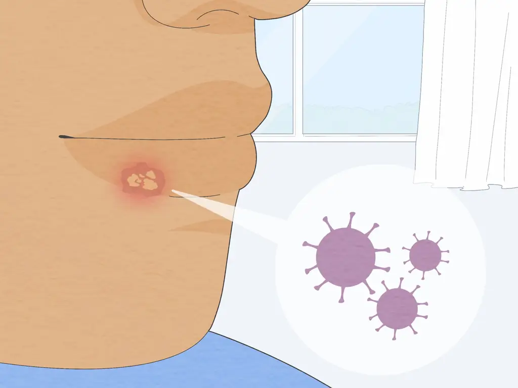 3 способа быстро избавиться от герпеса