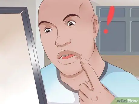 Как узнать, есть ли у вас герпес Шаг 4