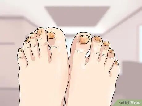 Узнайте, есть ли у вас невропатия в ногах Шаг 4