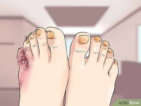 Узнайте, есть ли у вас невропатия в ногах Шаг 5