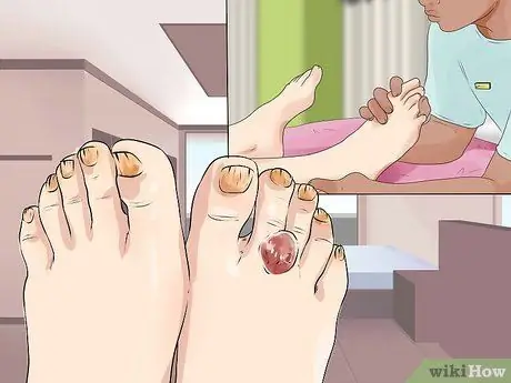 Узнайте, есть ли у вас невропатия в ногах Шаг 9