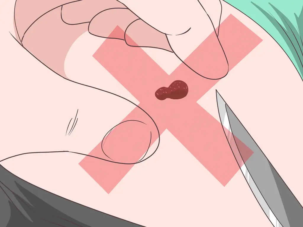 Простые способы остановить кровотечение у родинки: 10 шагов (с иллюстрациями)