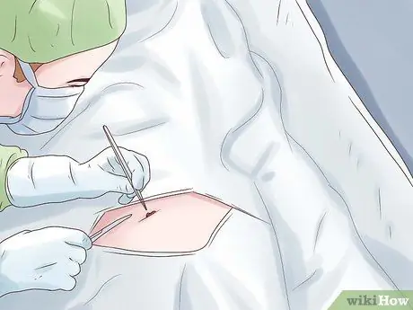 Лечить грыжу пищеводного отверстия диафрагмы Шаг 9