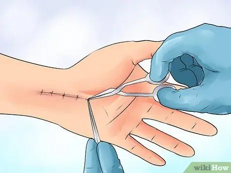 Упражнение после операции по каналу запястья Шаг 14