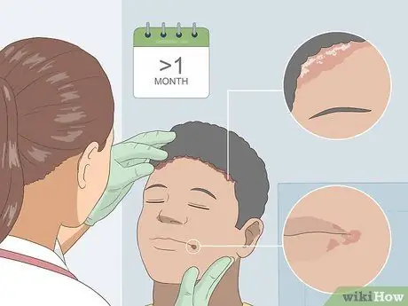 Вылечить угловой хейлит Шаг 6