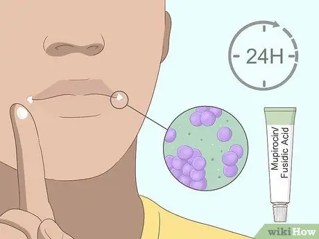 Вылечить угловой хейлит Шаг 8