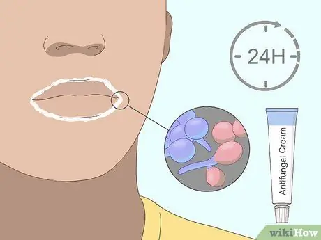 Вылечить угловой хейлит Шаг 9