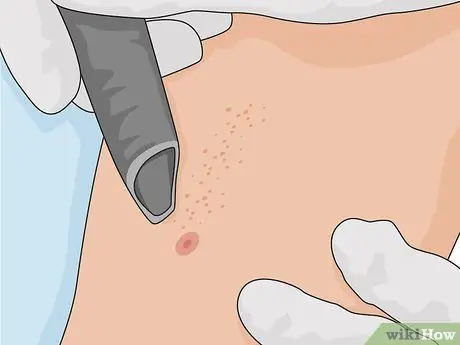 Удаление шрамов на ногах, шаг 18