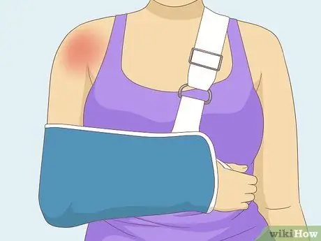 Выявление травмы вращательной манжеты плеча Шаг 11