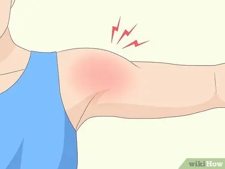 Выявление травмы вращательной манжеты плеча Шаг 4