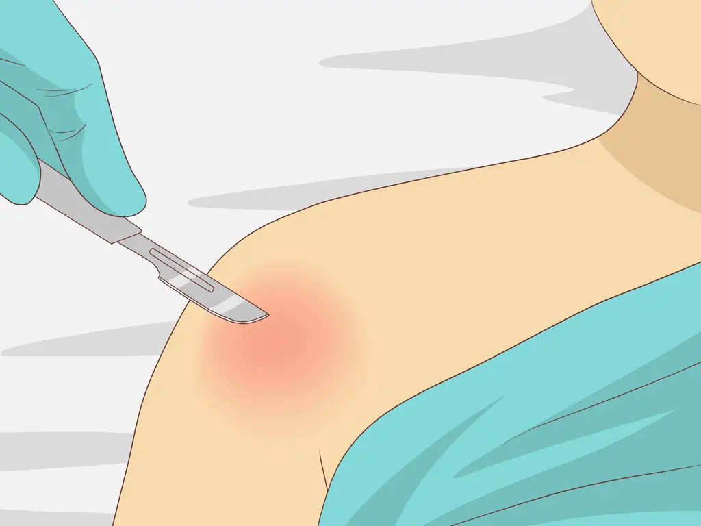 3 простых способа распознать травму вращательной манжеты плеча