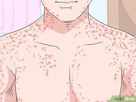 Распознайте симптомы марбургской геморрагической лихорадки Шаг 2