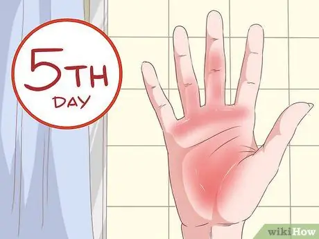 Распознайте симптомы марбургской геморрагической лихорадки Шаг 3