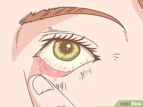 Распознайте симптомы марбургской геморрагической лихорадки Шаг 4