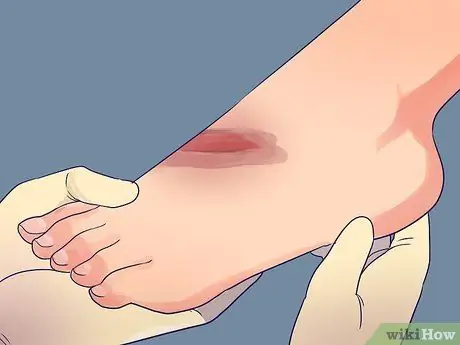 Смена повязки на рану Шаг 5