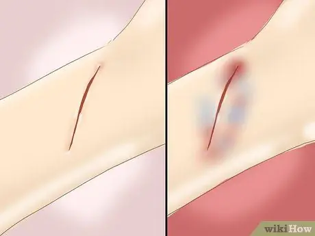 Очистите рану, шаг 2