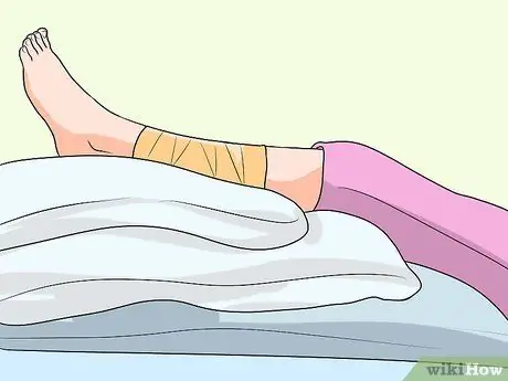 Вылечить гематому Шаг 5