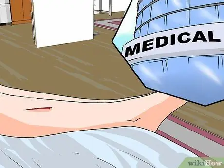 Вылечить гематому Шаг 9