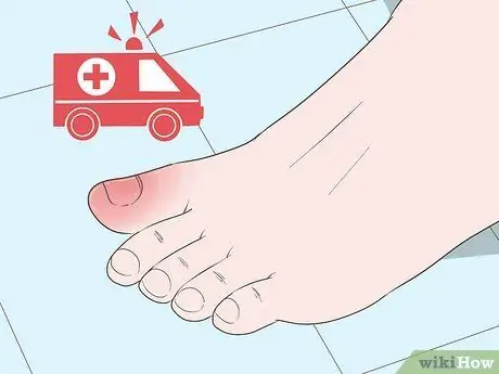 Лечение ушиба пальца ноги Шаг 12