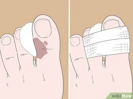 Вылечить ушиб пальца ноги Шаг 5