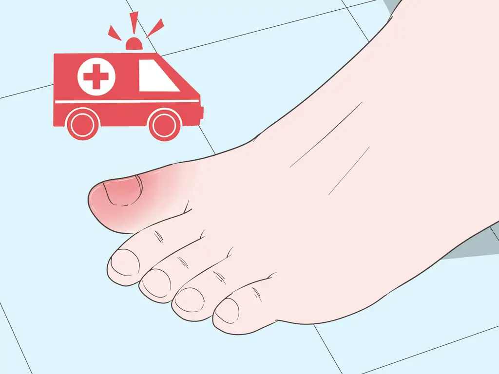 Как вылечить ушиб пальца ноги: 12 шагов (с иллюстрациями)