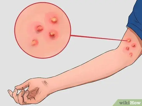 Распознайте симптомы аспергиллеза Шаг 9