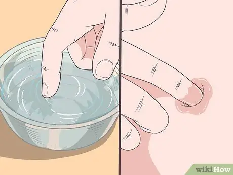 Лечите инфекцию в пупке Шаг 9