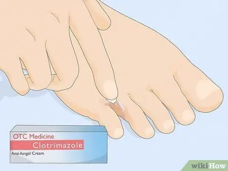 Избавиться от грибка стопы Шаг 1