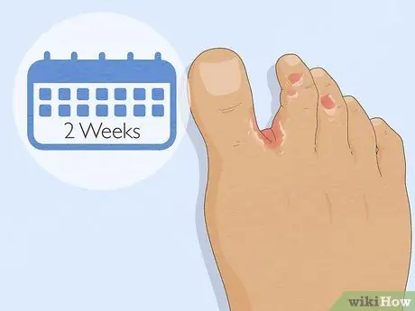 Избавиться от грибка стопы Шаг 6