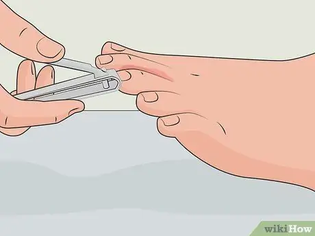 Избавиться от грибка стопы дома Шаг 02