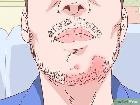 Предотвратить кожный грибок Шаг 11