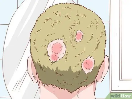 Предотвратить кожный грибок Шаг 12