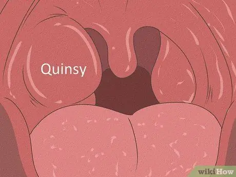 Дифференцировать бактериальный тонзиллит и вирусный тонзиллит Шаг 10