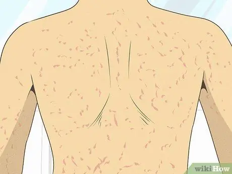 Дифференцировать бактериальный тонзиллит и вирусный тонзиллит Шаг 11