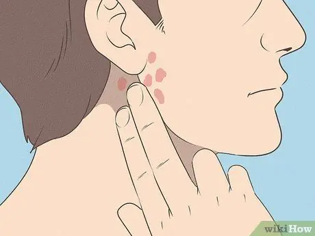 Дифференцировать бактериальный тонзиллит и вирусный тонзиллит Шаг 8