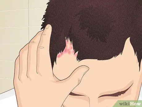 Шишки на коже головы. Шаг 1