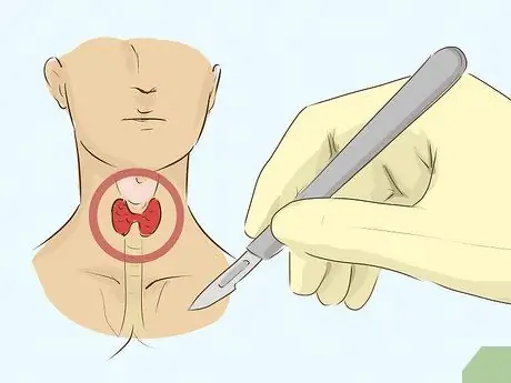 Лечить гипертиреоз у мужчин Шаг 11