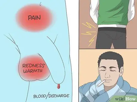 Лечить эпидидимит Шаг 1