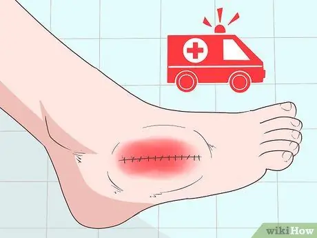 Уменьшить отек после операции Шаг 4