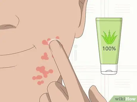 Лечить аллергическую реакцию на лице Шаг 11